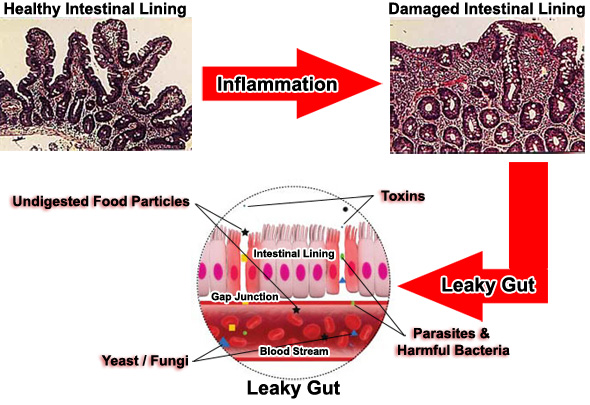 leaky gut process