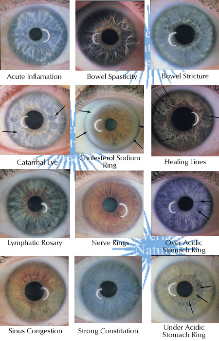 Managing Contact Lens-associated Red Eye