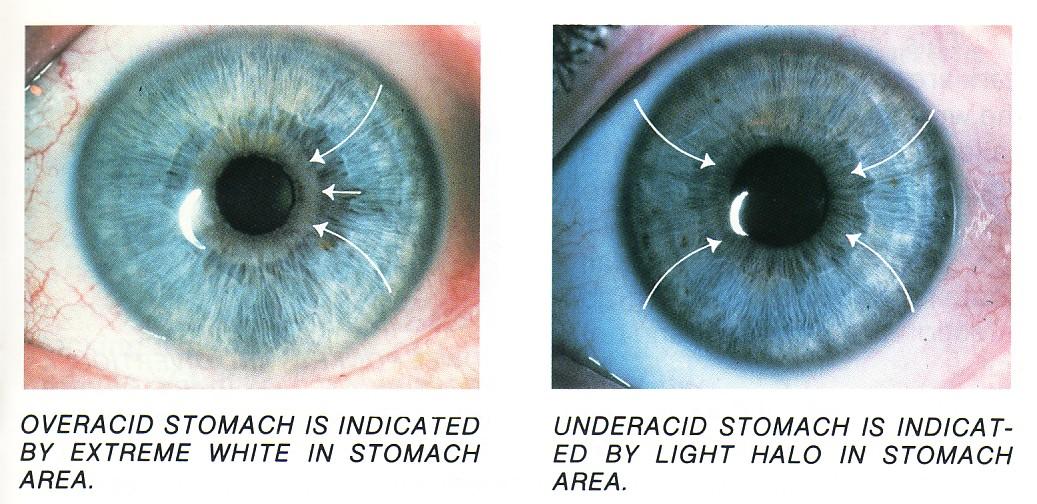 Latisse eye color change Stroma of IRIS Lightening